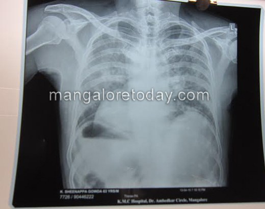  KMC Hospital Successfully Performs Surgery on a Right Hearted Patient